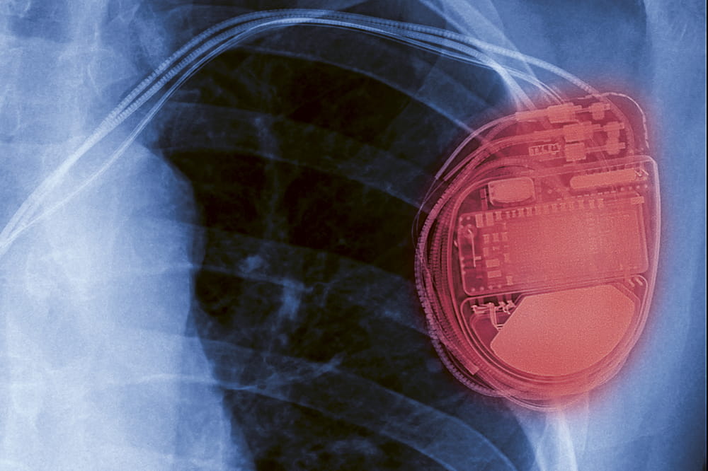 X-ray image of a pacemaker. 